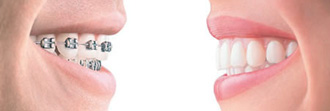 braces